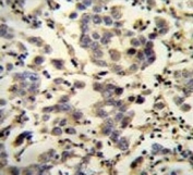 IHC testing of FFPE human testis carcinoma with C6orf58 antibody. HIER: steam section in pH6 citrate buffer for 20 min and allow to cool prior to staining.