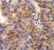 IHC testing of FFPE human hepatocarcinoma tissue with MINPP1 antibody. HIER: steam section in pH6 citrate buffer for 20 min and allow to cool prior to staining.