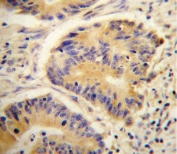 IHC testing of FFPE human colon carcinoma tissue with Alcohol dehydrogenase 4 antibody. HIER: steam section in pH6 citrate buffer for 20 min and allow to cool prior to staining.