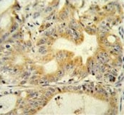 IHC testing of FFPE human colon carcinoma tissue with DcR3 antibody. HIER: steam section in pH6 citrate buffer for 20 min and allow to cool prior to staining.