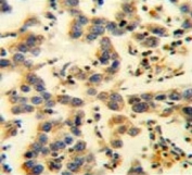 IHC testing of FFPE human testis carcinoma tissue with EMC1 antibody. HIER: steam section in pH6 citrate buffer for 20 min and allow to cool prior to staining.