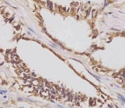 IHC testing of FFPE human lung adenocarcinoma tissue with IGF2BP1 antibody. HIER: steam section in pH6 citrate buffer for 20 min and allow to cool prior to staining.