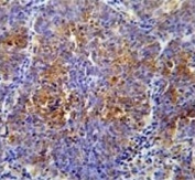 IHC testing of FFPE human lung carcinoma tissue with ATF7IP2 antibody. HIER: steam section in pH6 citrate buffer for 20 min and allow to cool prior to staining.