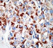 IHC testing of FFPE human cancer tissue with UBA3 antibody. HIER: steam section in pH6 citrate buffer for 20 min and allow to cool prior to staining.