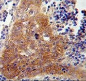 IHC testing of FFPE human lung carcinoma tissue with FBXW8 antibody. HIER: steam section in pH6 citrate buffer for 20 min and allow to cool prior to staining.