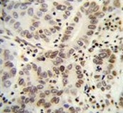 IHC testing of FFPE human hepatocarcinoma tissue with HIST1H2BJ antibody. HIER: steam section in pH6 citrate buffer for 20 min and allow to cool prior to staining.