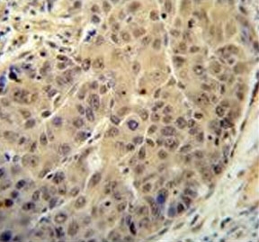 IHC testing of FFPE human hepatocarcinoma tissue with BUD13 antibody. HIER: steam section in pH6 citrate buffer for 20 min and allow to cool prior to staining.