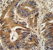 IHC testing of FFPE human colon carcinoma tissue with VPS52 antibody. HIER: steam section in pH6 citrate buffer for 20 min and allow to cool prior to staining.