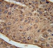 IHC testing of FFPE human hepatocarcinoma tissue with RPL27A antibody. HIER: steam section in pH6 citrate buffer for 20 min and allow to cool prior to staining.