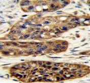 IHC testing of FFPE human esophageal carcinoma tissue with Estrogen-induced gene 121-like protein antibody. HIER: steam section in pH6 citrate buffer for 20 min and allow to cool prior to staining.
