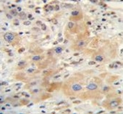 IHC testing of FFPE human hepatocarcinoma tissue with NR0B2 antibody. HIER: steam section in pH6 citrate buffer for 20 min and allow to cool prior to staining.