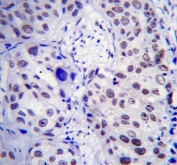 IHC testing of FFPE human breast carcinoma tissue with Upstream stimulatory factor 1 antibody. HIER: steam section in pH6 citrate buffer for 20 min and allow to cool prior to staining.