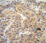 IHC testing of FFPE human hepatocarcinoma tissue with NARS antibody. HIER: steam section in pH6 citrate buffer for 20 min and allow to cool prior to staining.
