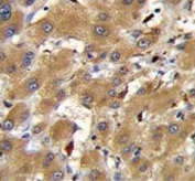 IHC testing of FFPE human hepatocarcinoma tissue with Haptoglobin-related protein antibody. HIER: steam section in pH6 citrate buffer for 20 min and allow to cool prior to staining.