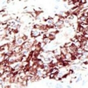 IHC testing of FFPE human cancer tissue with HDAC11 antibody. HIER: steam section in pH6 citrate buffer for 20 min and allow to cool prior to staining.