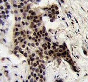 IHC testing of FFPE human bladder carcinoma tissue with UBXN2A antibody. HIER: steam section in pH6 citrate buffer for 20 min and allow to cool prior to staining.