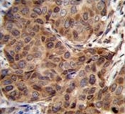 IHC testing of FFPE human breast carcinoma tissue with Sorting nexin-24 antibody. HIER: steam section in pH6 citrate buffer for 20 min and allow to cool prior to staining.