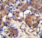 IHC testing of FFPE human breast carcinoma tissue with KNG1 antibody. HIER: steam section in pH6 citrate buffer for 20 min and allow to cool prior to staining.