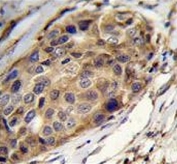 IHC testing of FFPE human breast carcinoma tissue with Slingshot homolog 3 antibody. HIER: steam section in pH6 citrate buffer for 20 min and allow to cool prior to staining.