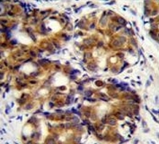 IHC testing of FFPE human breast carcinoma tissue with CD168 antibody. HIER: steam section in pH6 citrate buffer for 20 min and allow to cool prior to staining.