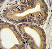 IHC testing of FFPE human prostate carcinoma tissue with TRIM65 antibody. HIER: steam section in pH6 citrate buffer for 20 min and allow to cool prior to staining.