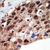 IHC testing of FFPE human cancer tissue with SETD7 antibody. HIER: steam section in pH6 citrate buffer for 20 min and allow to cool prior to staining.