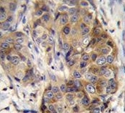 IHC testing of FFPE human breast carcinoma tissue with GSR antibody. HIER: steam section in pH6 citrate buffer for 20 min and allow to cool prior to staining.