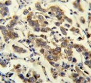 IHC testing of FFPE human testis carcinoma tissue with MBD3L3 antibody. HIER: steam section in pH6 citrate buffer for 20 min and allow to cool prior to staining.