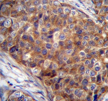 IHC testing of FFPE human breast carcinoma tissue with COX7A2L antibody. HIER: steam section in pH6 citrate buffer for 20 min and allow to cool prior to staining.