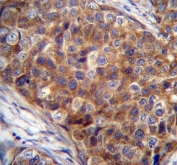 IHC testing of FFPE human breast carcinoma tissue with COX7A2L antibody. HIER: steam section in pH6 citrate buffer for 20 min and allow to cool prior to staining.