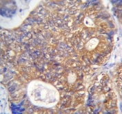IHC testing of FFPE human colon carcinoma tissue with ADE2 antibody. HIER: steam section in pH6 citrate buffer for 20 min and allow to cool prior to staining.