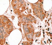 IHC testing of FFPE human breast cancer tissue with Bcl-G antibody. HIER: steam section in pH6 citrate buffer for 20 min and allow to cool prior to staining.