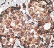 IHC testing of FFPE human breast cancer tissue with HtrA3 antibody. HIER: steam section in pH6 citrate buffer for 20 min and allow to cool prior to staining.