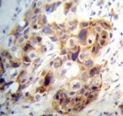 IHC testing of FFPE human breast carcinoma tissue with PI15 antibody. HIER: steam section in pH6 citrate buffer for 20 min and allow to cool prior to staining.