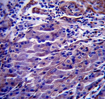 IHC testing of FFPE human breast carcinoma tissue with CDKN1A antibody. HIER: steam section in pH6 citrate buffer for 20 min and allow to cool prior to staining.