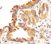 IHC testing of FFPE human lung adenocarcinoma tissue with Pulmonary surfactant-associated protein C antibody. HIER: steam section in pH6 citrate buffer for 20 min and allow to cool prior to staining.