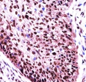 IHC testing of FFPE human esophagus carcinoma tissue with Splicing factor 3B subunit 1 antibody. HIER: steam section in pH6 citrate buffer for 20 min and allow to cool prior to staining.