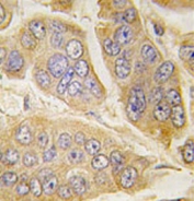 IHC testing of FFPE human breast cancer tissue with NANOS1 antibody. HIER: steam section in pH6 citrate buffer for 20 min and allow to cool prior to staining.