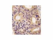 IHC testing of FFPE human prostate carcinoma tissue with Latexin antibody. HIER: steam section in pH6 citrate buffer for 20 min and allow to cool prior to staining.
