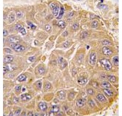 IHC testing of FFPE human hepatocarcinoma tissue with ALDH5A1 antibody. HIER: steam section in pH6 citrate buffer for 20 min and allow to cool prior to staining.