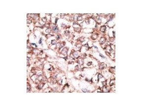 IHC testing of FFPE human cancer tissue with Dickkopf-2 antibody. HIER: steam section in pH6 citrate buffer for 20 min and allow to cool prior to staining.
