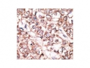 IHC testing of FFPE human cancer tissue with Dickkopf-2 antibody. HIER: steam section in pH6 citrate buffer for 20 min and allow to cool prior to staining.