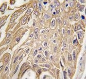 IHC testing of FFPE human lung carcinoma tissue with SIGLEC5 antibody. HIER: steam section in pH6 citrate buffer for 20 min and allow to cool prior to staining.
