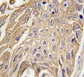 IHC testing of FFPE human lung carcinoma tissue with SIGLEC5 antibody. HIER: steam section