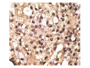 IHC testing of FFPE human breast cancer tissue with ATG4B antibody. HIER: steam section in pH6 citrate buffer for 20 min and allow to cool prior to staining.