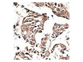 IHC testing of FFPE human cancer tissue with ATG4C antibody. HIER: steam section in pH6 citrate buffer for 20 min and allow to cool prior to staining.