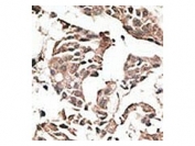 IHC testing of FFPE human cancer tissue with ATG4C antibody. HIER: steam section in pH6 citrate buffer for 20 min and allow to cool prior to staining.