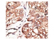 IHC testing of FFPE human cancer tissue with ATG4D antibody. HIER: steam section in pH6 citrate buffer for 20 min and allow to cool prior to staining.