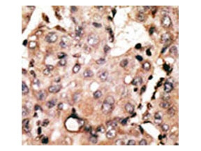 IHC testing of FFPE human cancer tissue with Autophagin 4D antibody. HIER: steam section in pH6 citrate buffer for 20 min and allow to cool prior to staining.
