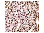 IHC testing of FFPE human breast cancer tissue with ATG9A antibody. HIER: steam section in pH6 citrate buffer for 20 min and allow to cool prior to staining.